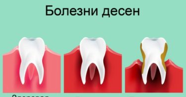 вейпинг вызывает болезни десен