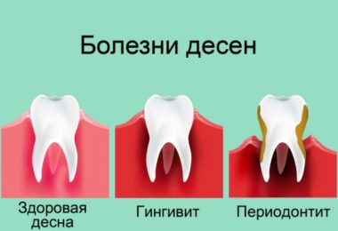 вейпинг вызывает болезни десен